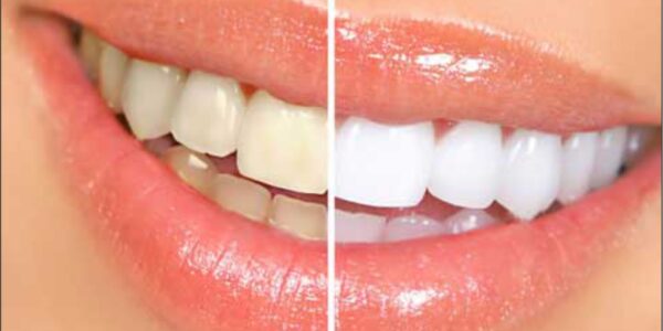 Tooth Whitening Treatment