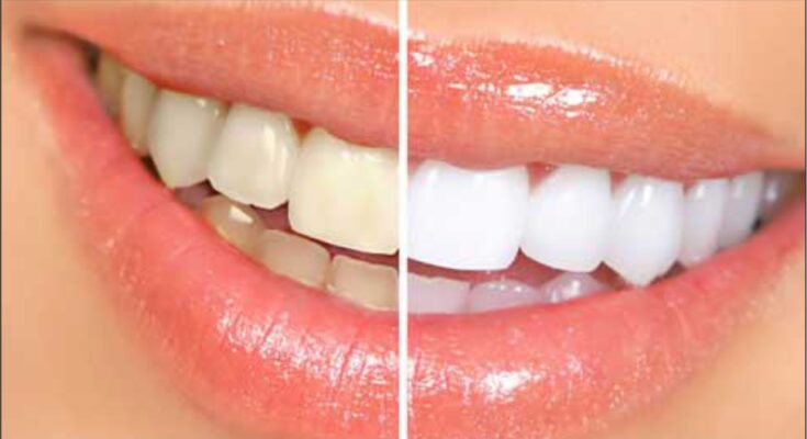 Tooth Whitening Treatment